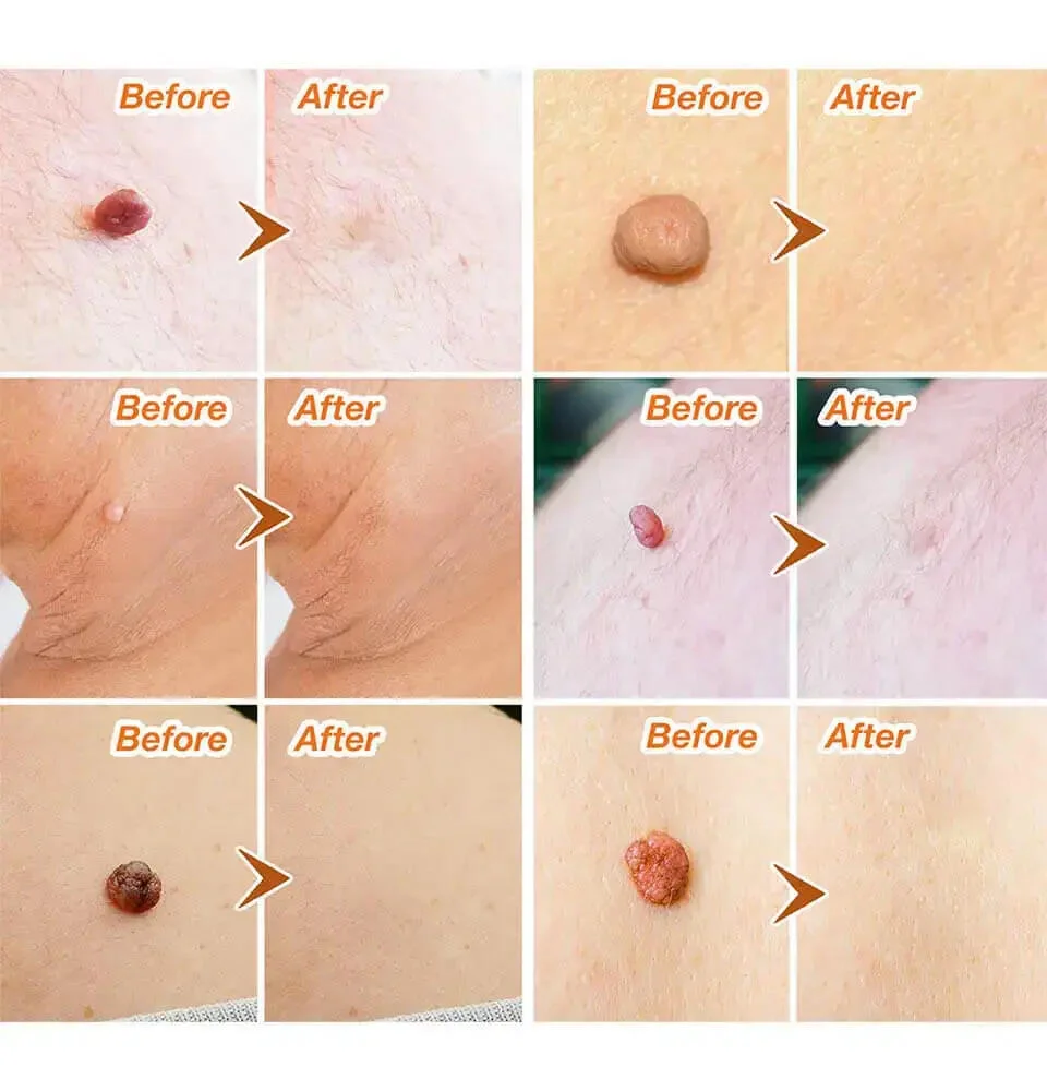 Ingredients of SkinCell Skin Tag Remover