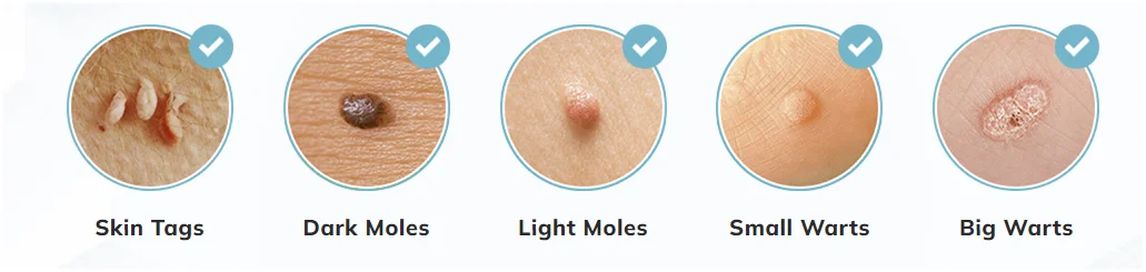 Benefits of SkinCell Skin Tag Remover